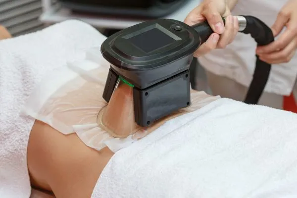 Image of person having fat freezing treatment to help weight gain Feltham