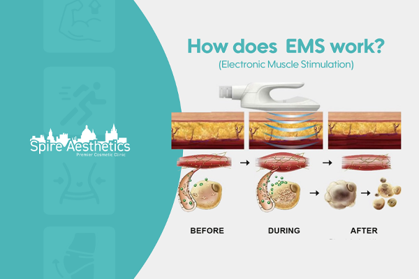 EMS treatment for post pregnancy weight loss treatment Feltham