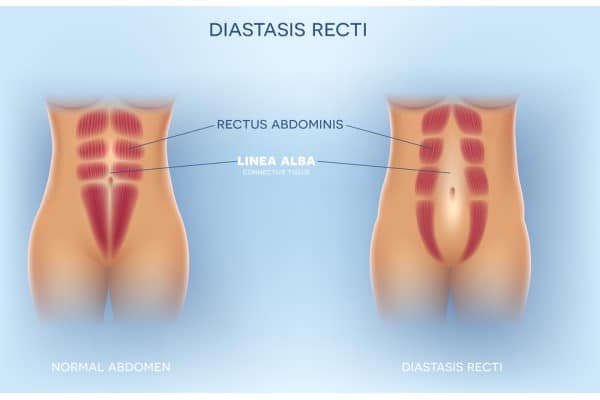 What Non-Surgical Options Are Available for Diastasis Recti Feltham?