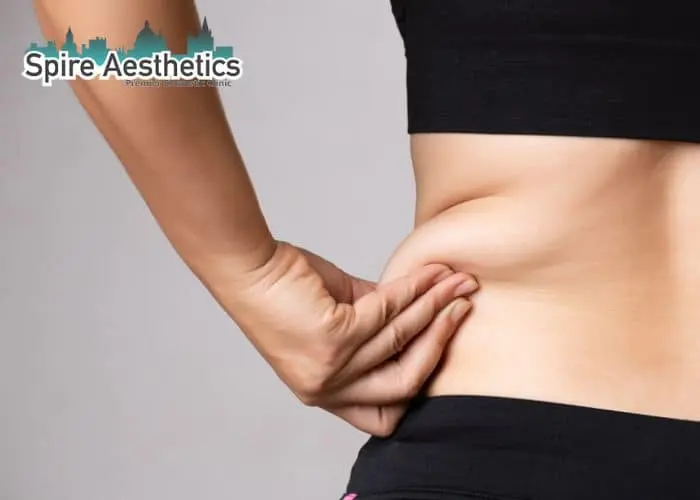 Image of woman pinching fat on their hips Feltham. Fat Freezing treatment