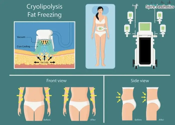 Fat freezing treatment Feltham benefits for competitions to remove stubborn fat deposits.