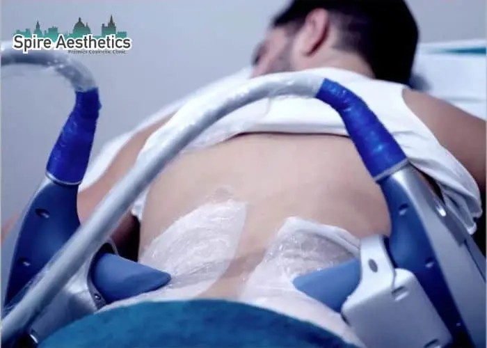 Man having fat freezing treatment done on love handles before a competitions Feltham to create a sculpted look.