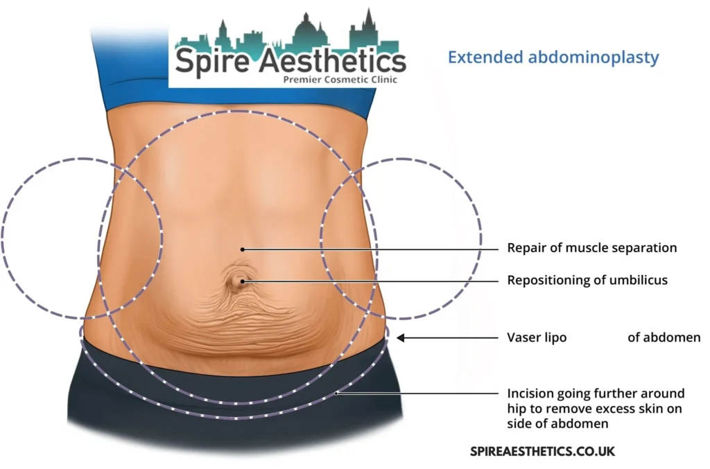 Understanding Loose Skin After Gastric Band Feltham Surgery and HIFU Treatment