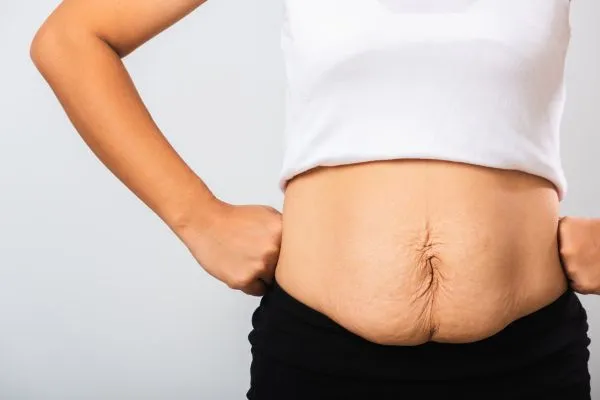 Image of a woman's stomach after weight loss with sagging skin following a gastric band Feltham