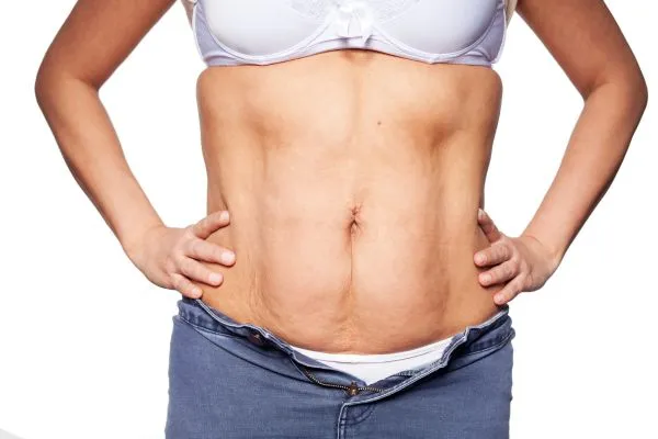 sagging skin on woman's stomach after weight loss injections Feltham