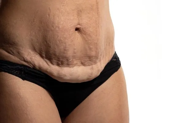 Image of womans stomach after weight loss injections Feltham showing saggy skin