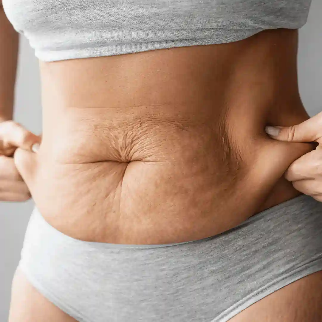 Is It Normal to Have Loose Skin After Pregnancy Feltham?