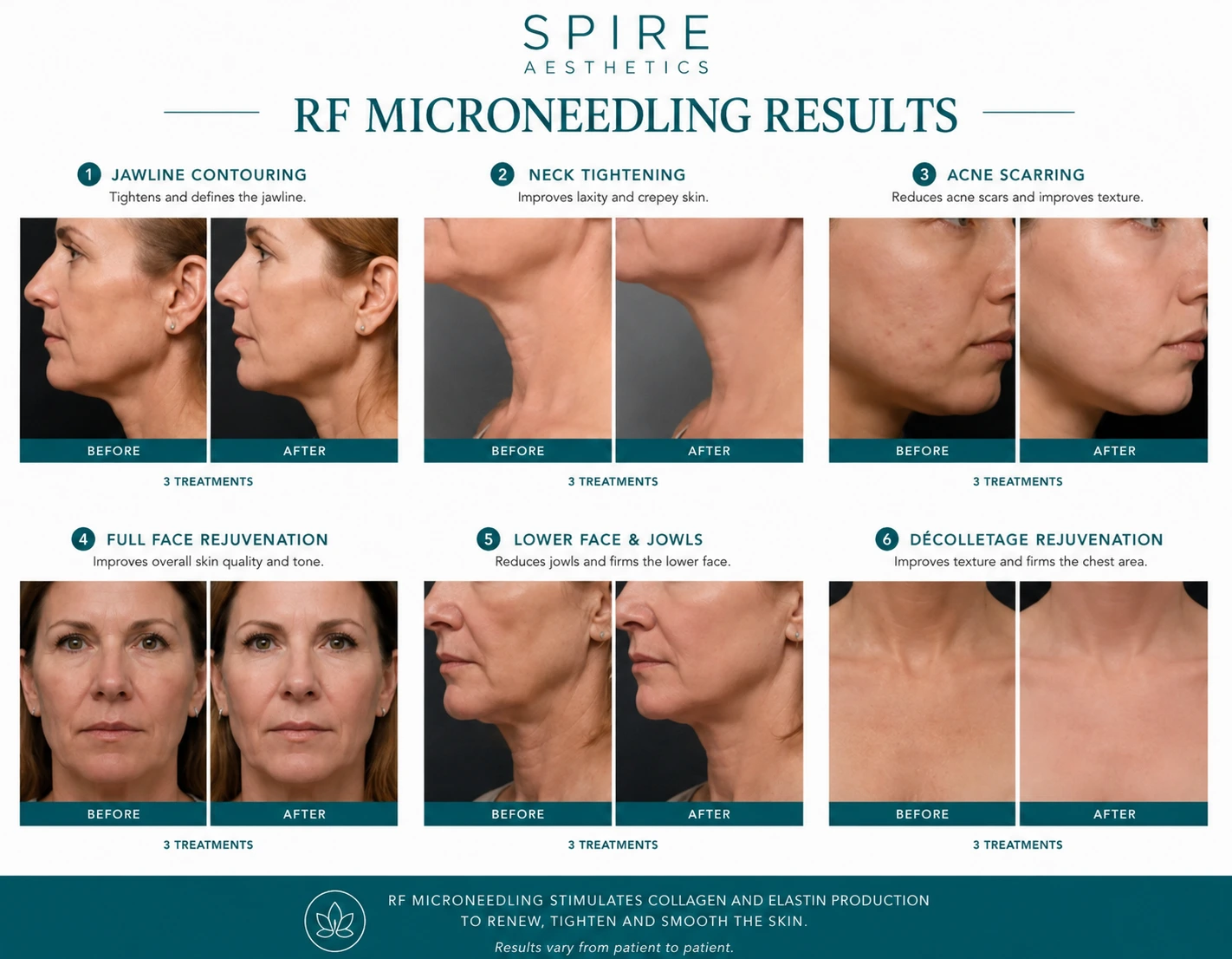 RF Microneedling Skin tightening Feltham results