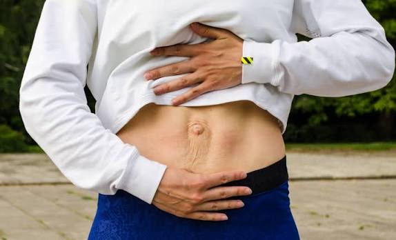 When Could Diastasis Recti Be the Missing Piece of the Puzzle Feltham?