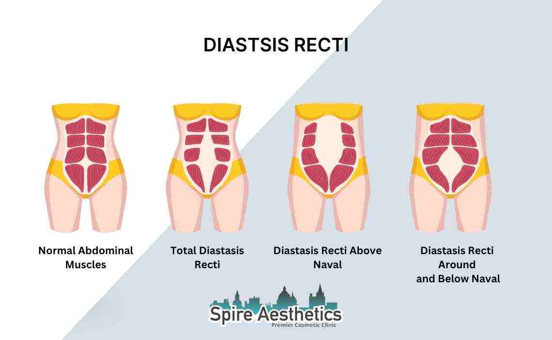 Is Non-Surgical Diastasis Recti Treatment Right for You? Common Concerns Answered Feltham